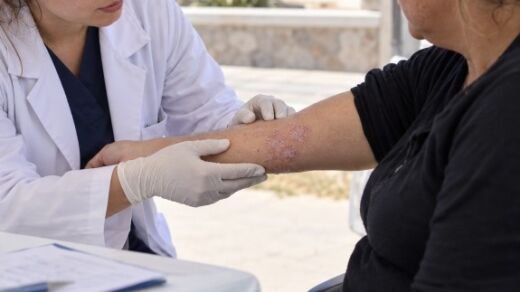 psoriasis